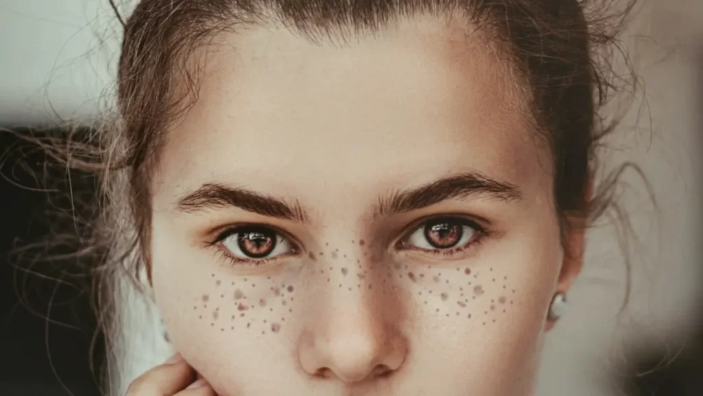 How to prevent pimples on Face